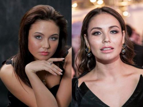 Ляйсан УтяшеваХирурги, посмотрев на фото гимнастки, сделали вывод, что она сделала аугментацию (увеличение) и нижней, и верхней губы. "Изначально емкость ткани губ была невелика, при чрезмерном наполнении гелем как раз и получается такой «натянутый» вид", - отметили медики.