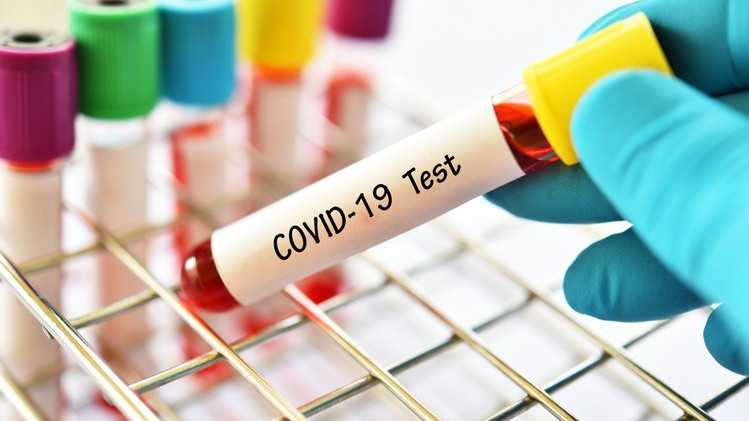 Еще 149 случаев коронавируса выявили за сутки в регионе